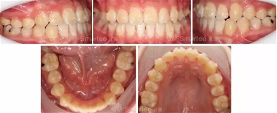 【病例展示】Smartee隱形正畸中國好病例鑒賞第三波
