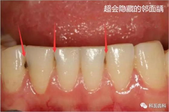 牙縫間的黑線是鄰面齲，還一壞壞倆，巧用它幫你渡過一“劫”