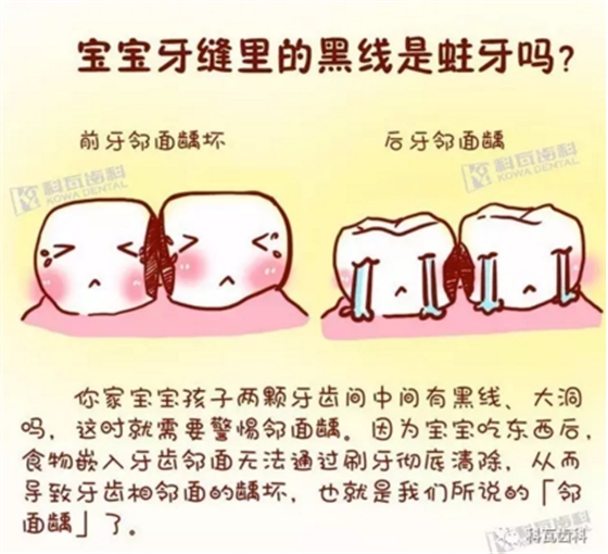 牙縫間的黑線是鄰面齲，還一壞壞倆，巧用它幫你渡過一“劫”