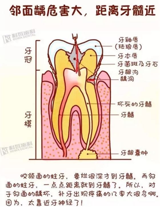 牙縫間的黑線是鄰面齲，還一壞壞倆，巧用它幫你渡過一“劫”