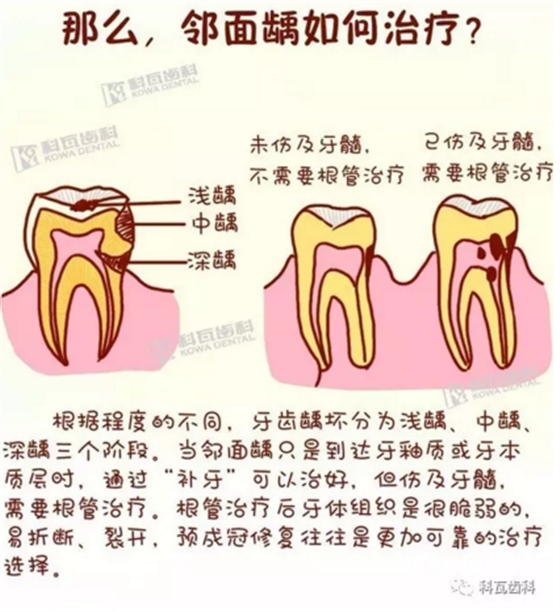 牙縫間的黑線是鄰面齲，還一壞壞倆，巧用它幫你渡過一“劫”