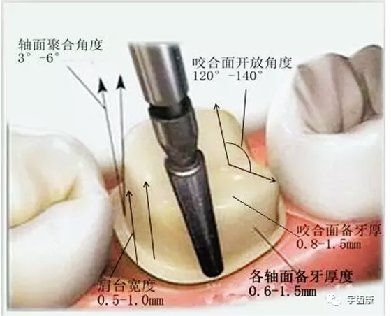 影響全瓷牙冠裂的因素有哪些？