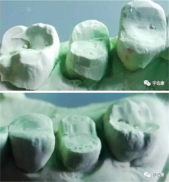 影響全瓷牙冠裂的因素有哪些？