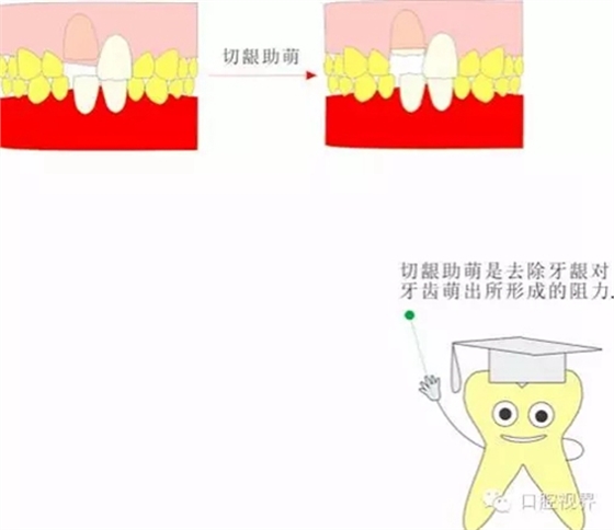  “什么是牙周袋沖洗？”