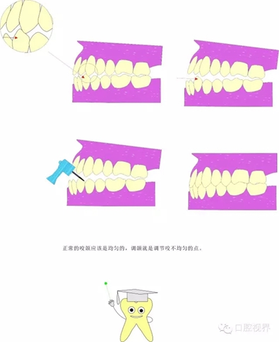 【愛牙科普知識300問】 “什么是牙間牽引？”