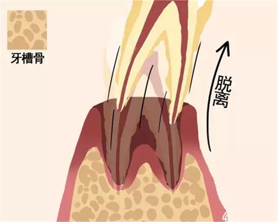 【愛牙科普】牙齒是如何脫落的…