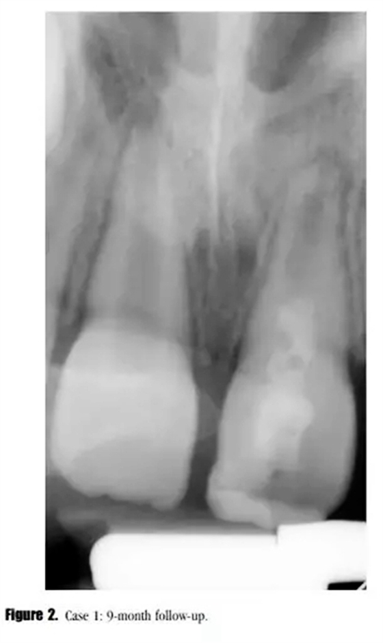 病例分享｜牙髓血管再生治療失敗后的牙根發(fā)育：2例