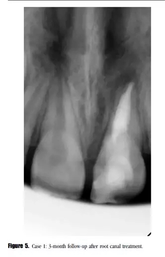 病例分享｜牙髓血管再生治療失敗后的牙根發(fā)育：2例
