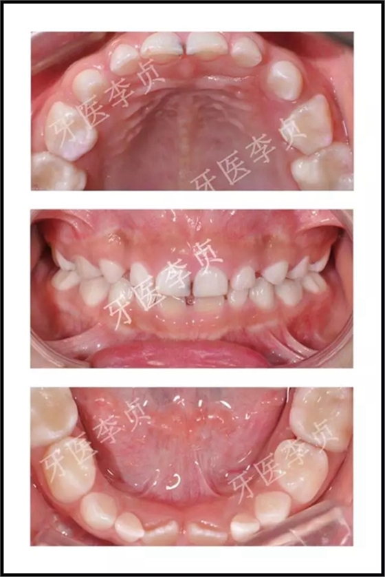 兒牙病例|兒童蛀牙的修復(fù)