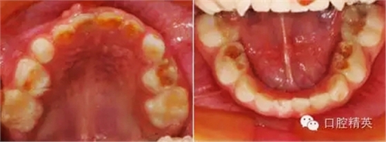 全麻下兒科治療+兒牙樹脂充填