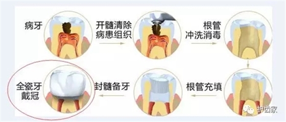 根管治療后，可以不做烤瓷牙嗎？