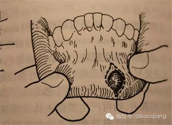 粘液腺囊腫