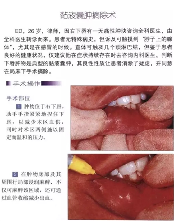 粘液腺囊腫切除術(shù)