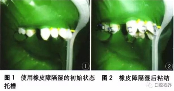 橡皮障，是用還是不用？