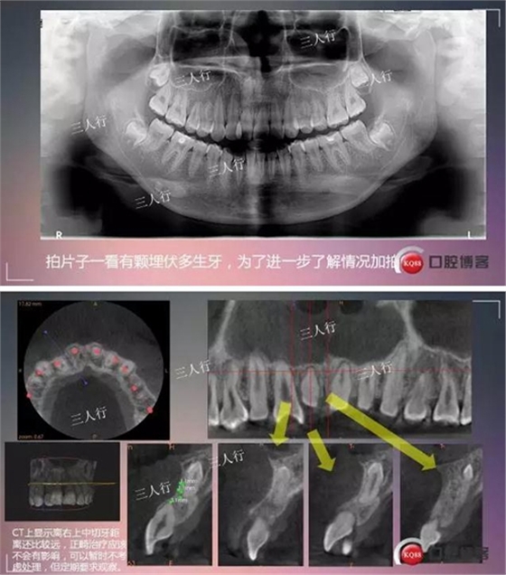 深部埋伏多生牙——微創(chuàng)處理  