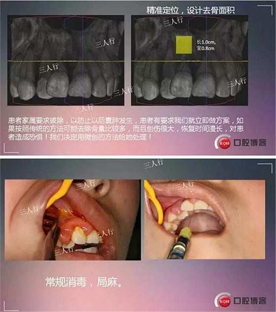 深部埋伏多生牙——微創(chuàng)處理  