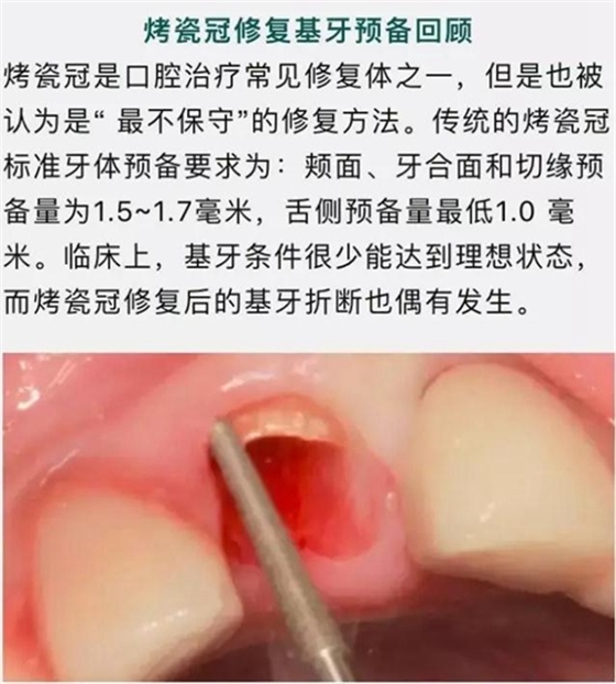 做全冠修復時基牙根面暴露，如何備牙？