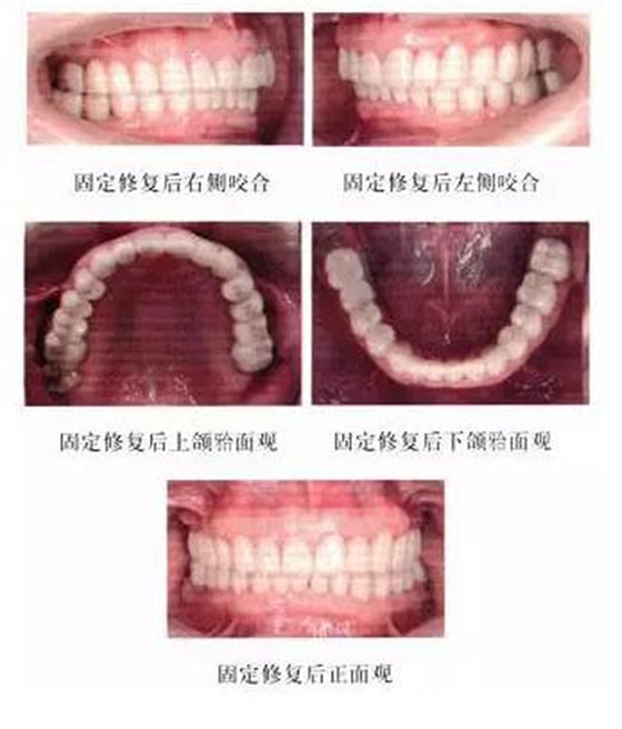 正畸修復聯(lián)合咬合重建1例 