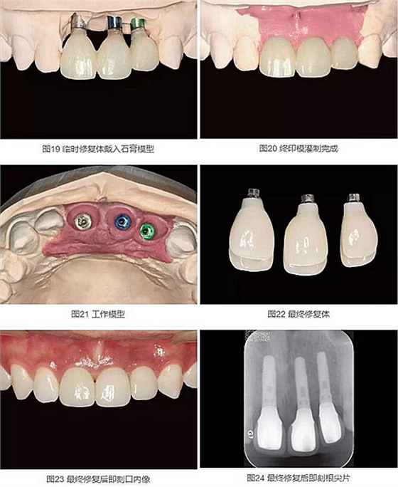 上頜多顆相鄰前牙的“精確化”即刻種植修復