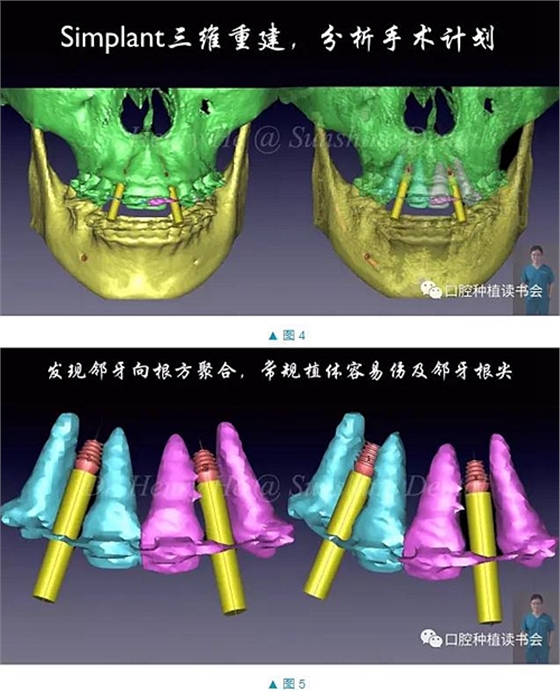 短種植體在前牙美學(xué)區(qū)應(yīng)用的臨床病例報(bào)道（上）