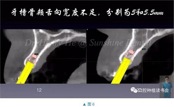 短種植體在前牙美學(xué)區(qū)應(yīng)用的臨床病例報(bào)道（上）