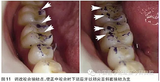 凸凹式后牙咬合接觸及其臨床意義——王美青教授