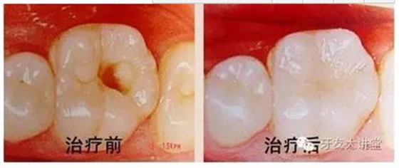 12歲前必須處理的20種兒童牙頜畸形【口腔科普】