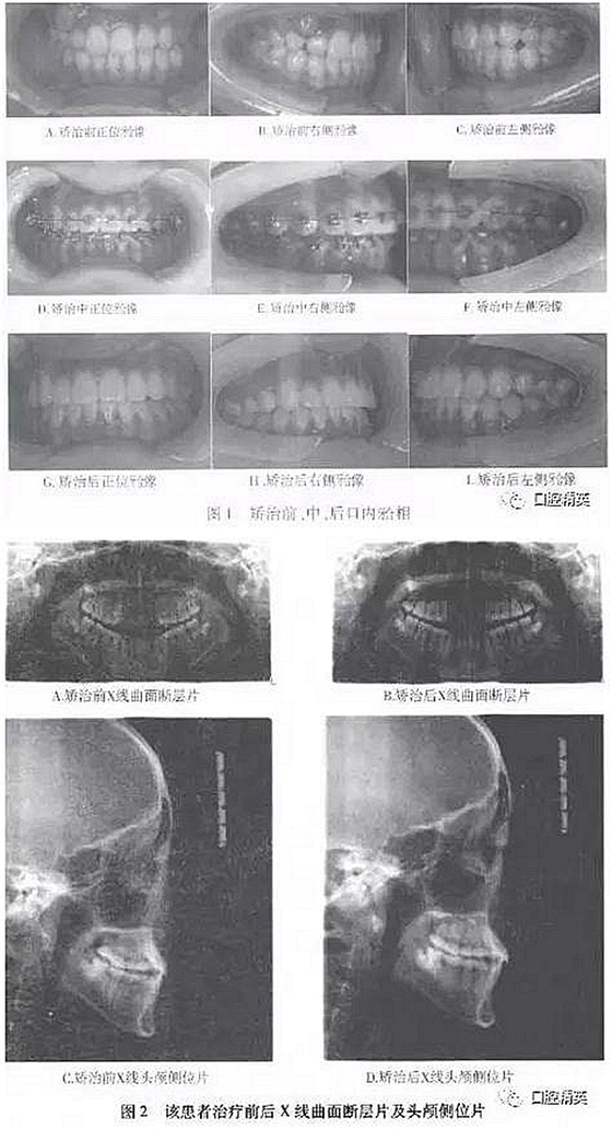 尖牙完全唇側(cè)錯位擁擠，矯正1例  