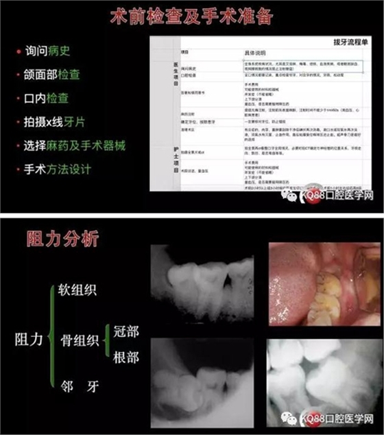 智齒拔除