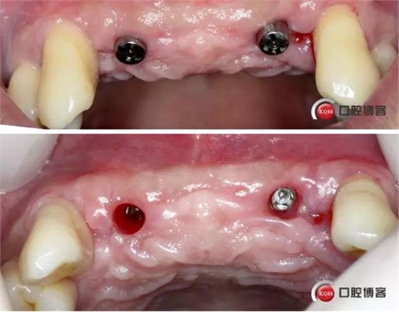 一例前牙重度牙周病8個(gè)月的種植漫長(zhǎng)修復(fù)