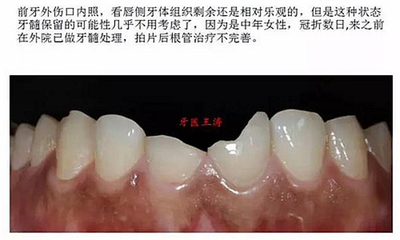 前牙外傷冠延長+全瓷冠修復(fù)