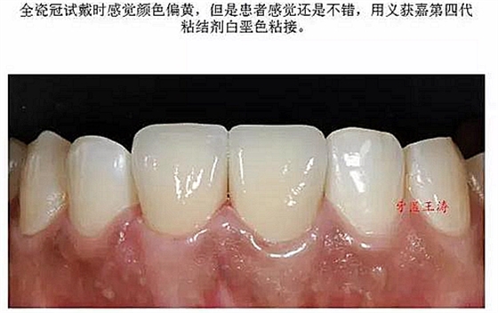 前牙外傷冠延長+全瓷冠修復(fù)