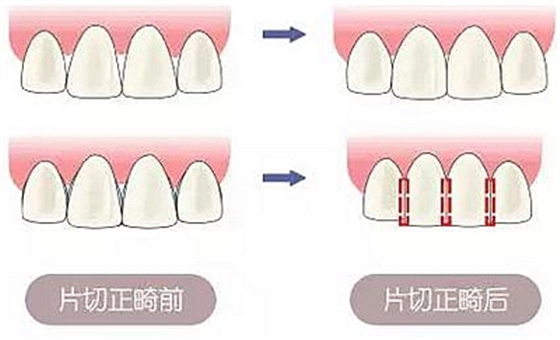 醫(yī)生方案里的鄰面去釉，究竟是什么？