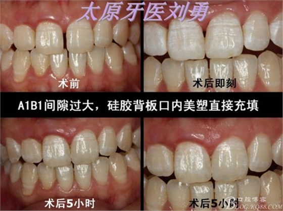 劉勇：斷牙再粘結(jié)兩例病例 