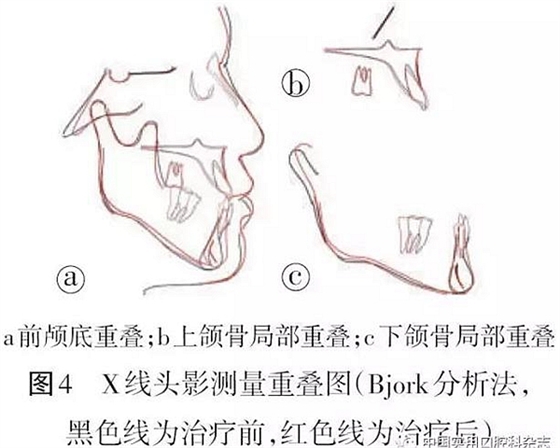 病例報告 | 上頜種植體支抗Ⅲ類牽引矯治骨性Ⅲ類反牙合伴開牙合1例報告