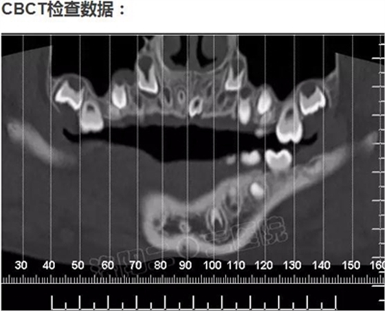 多生牙的拔除總原則：早發(fā)現(xiàn)，早處理！