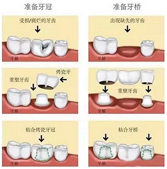 一位資深牙醫(yī)的總結(jié) | 如何減輕患者鑲牙后酸痛癥狀的措施！