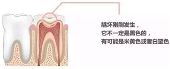 【收藏】關(guān)于補(bǔ)牙，知道這些就夠了！