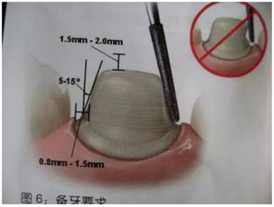 醫(yī)生，我的烤瓷牙上有個(gè)黑線怎么回事？