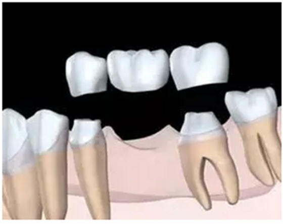 固定假牙（烤瓷牙）的致命缺點(diǎn)