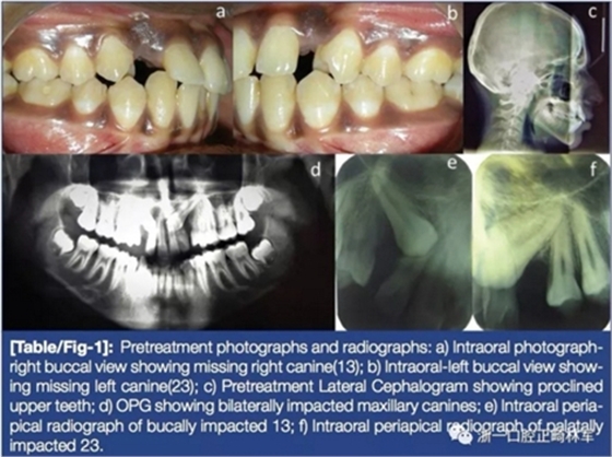 文獻(xiàn)優(yōu)秀正畸病例賞析--牙周加速成骨正畸（PAOO）輔助的腭側(cè)埋伏尖牙牽引矯治及5年跟蹤隨訪