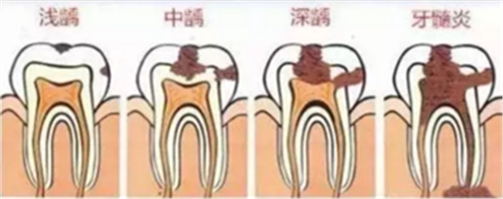 當(dāng)心“腹黑”齲齒，牙齒有個(gè)小洞也要補(bǔ)！