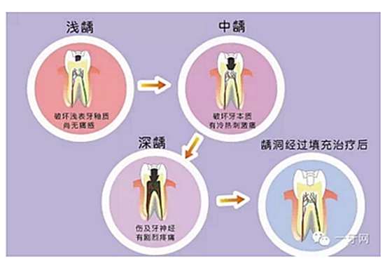 詳解牙疼的原因分幾種？