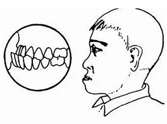 孩子怎么會(huì)長(zhǎng)出雙排牙？