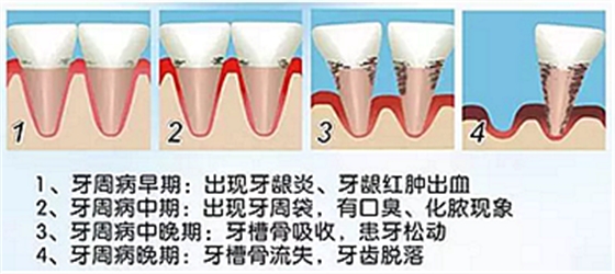 牙周病發(fā)展過程