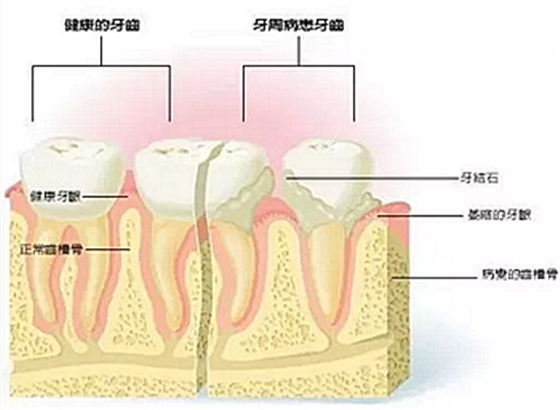 牙周病發(fā)展過程