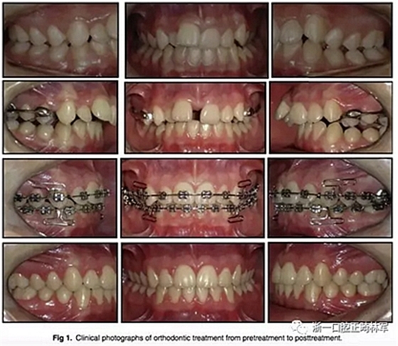 正畸文獻(xiàn)閱讀--正畸過(guò)程中牙根移動(dòng)的三維監(jiān)測(cè)