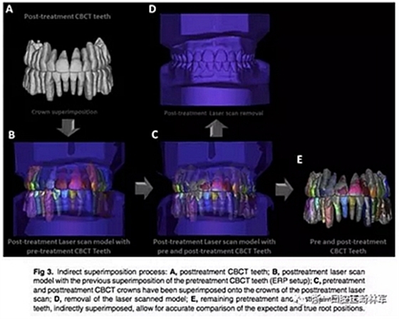 正畸文獻(xiàn)閱讀--正畸過(guò)程中牙根移動(dòng)的三維監(jiān)測(cè)