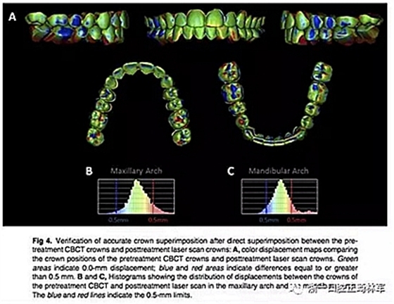 正畸文獻(xiàn)閱讀--正畸過(guò)程中牙根移動(dòng)的三維監(jiān)測(cè)