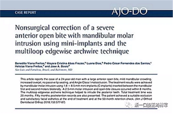 文獻優(yōu)秀正畸病例賞析-通過微種植釘及多曲方絲技術壓低下頜磨牙非手術矯治嚴重前牙開合患者1例